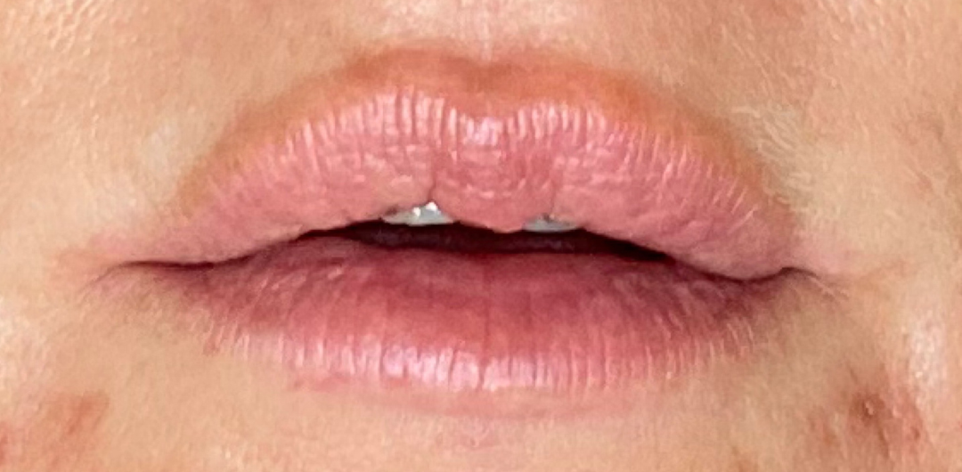 efter-lips1