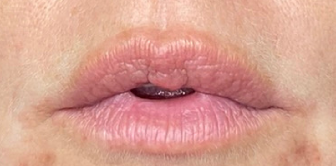 før-lips1