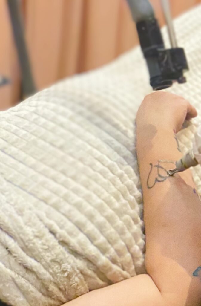 Fjernelse af tatovering – Healux Klinikken